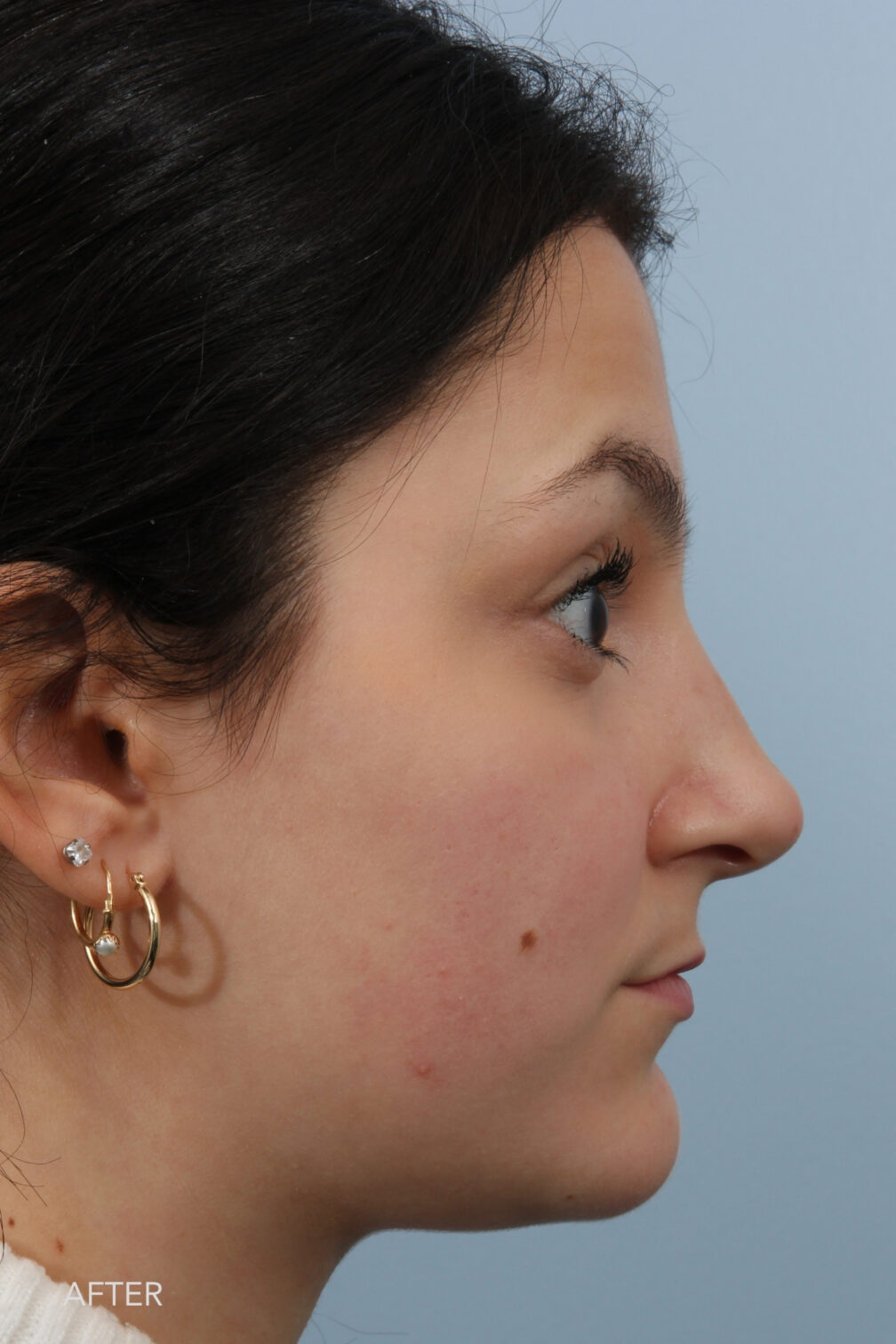 Rhinoplasty & Nasal Reconstruction Gallery | The Williams Center ...
