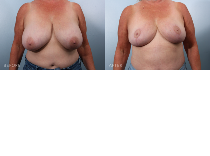 A photo of a woman's body before and after the Breast Augmentation procedure. The before picture shows a lack of fullness in her upper pole, leading to a flatter or less rounded appearance. The after photo shows a more enhanced upper pole fullness, creating a perkier and more youthful appearance. | Albany, Latham, Saratoga NY, Plastic Surgery