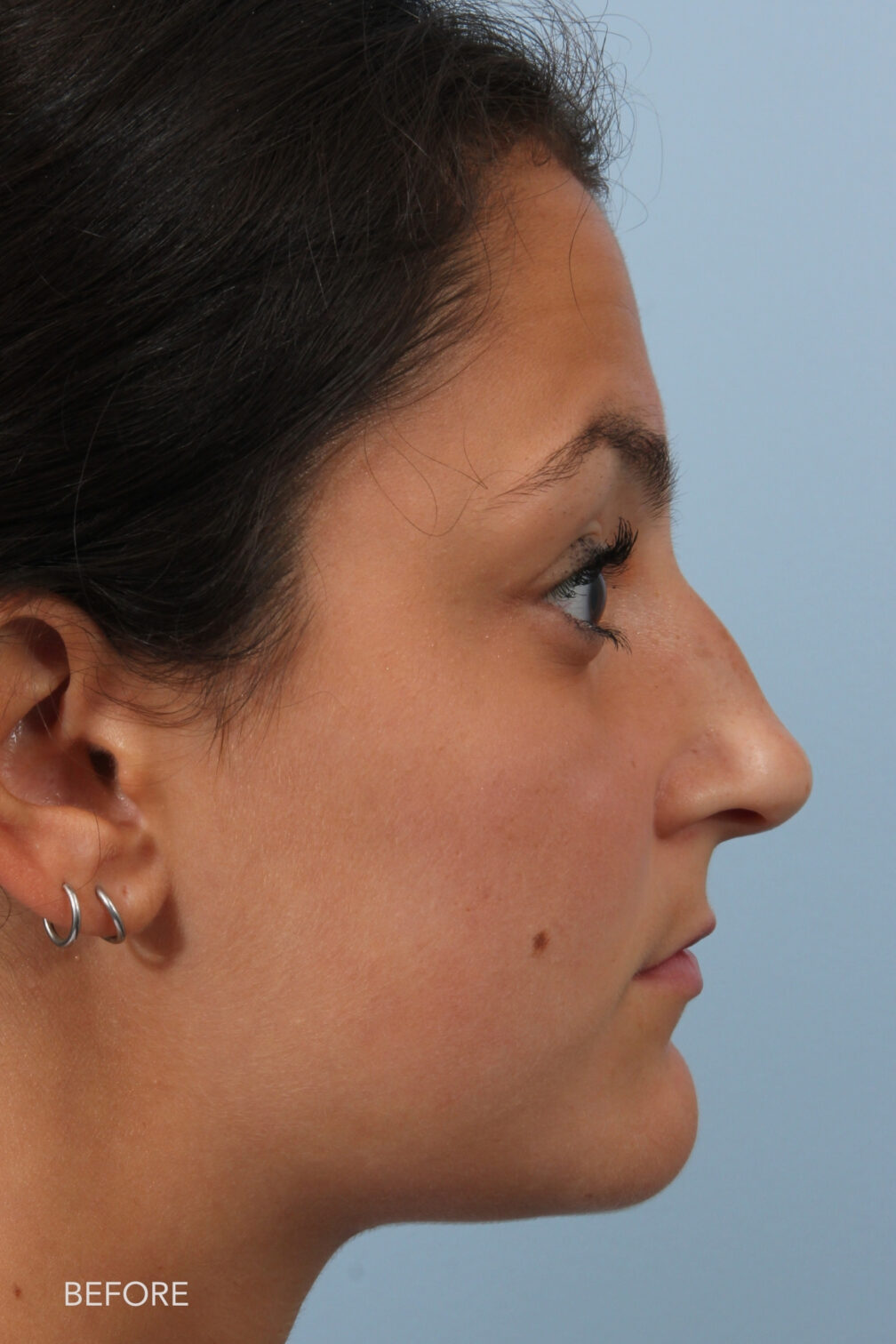 Rhinoplasty & Nasal Reconstruction Pictures | Williams Center Williams ...