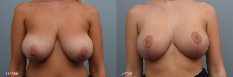 Side by side before and after of a woman's breasts before and after breast reduction surgery. Her breasts were large and drooping before surgery, now they are smaller and lifted but still large in appearance. | Albany, Latham, Saratoga NY, Plastic Surgery