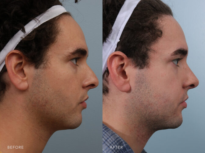 Side by side before and after of a young man's face from the side profile view before and after rhinoplasty surgery. Before surgery his nose had a hump and made it appear larger. After rhinoplasty surgery the hump has been removed and his nose is smaller in appearance but still masculine. | Albany, Latham, Saratoga NY, Plastic Surgery