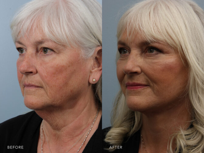 Side by side before and after of a womans face from an oblique angle before and after a facelift procedure. She had loose skin around her jawline and face that need to be removed and tightened. | Albany, Latham, Saratoga NY, Plastic Surgery