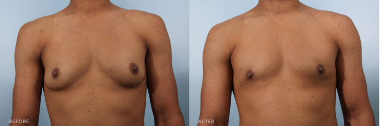Side by side before and after of a man's chest from the front view. Before gynecomastia surgery his chest resembled female breasts, and after surgery the extra volume was removed and now his chest is flat. | Albany, Latham, Saratoga NY, Plastic Surgery