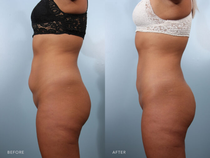 Side by side before and after of a woman's body from the side profile view from the neck down before and after liposuction in albany, ny. She had a pouch of fat in the lower abdomen that has been removed, and her back has been sculpted. | Albany, Latham, Saratoga NY, Plastic Surgery