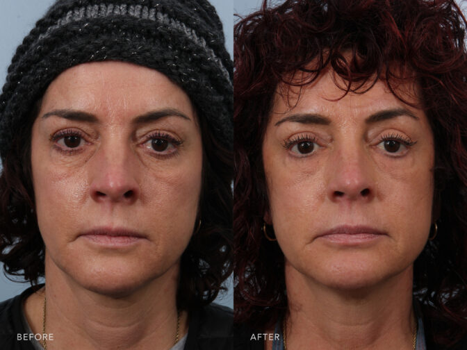 Side by side before and after of a woman who had an upper and lower blepharoplasty procedure in Albany, NY. Her eyelids are less droopy and under eye bags have been removed. | Albany, Latham, Saratoga NY, Plastic Surgery