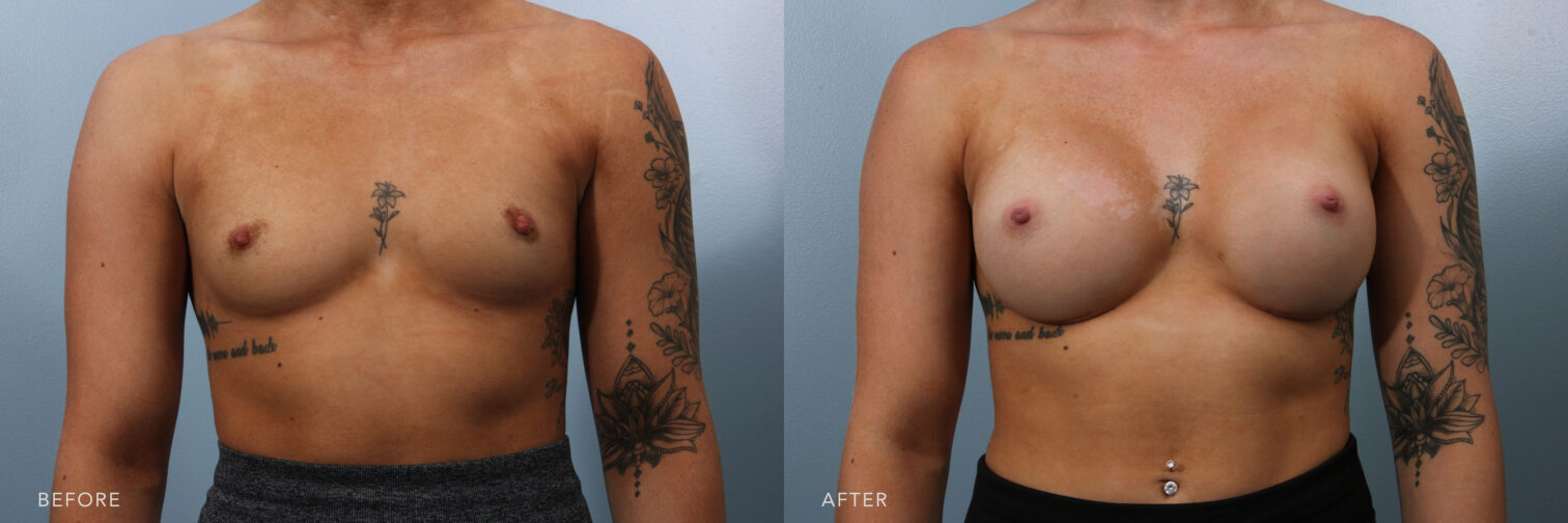 Side by side before and after of a woman's breasts from the front angle before breast augmentation surgery. Her breasts were small and flat and now they are several cup sizes bigger and more round. | Albany, Latham, Saratoga NY, Plastic Surgery