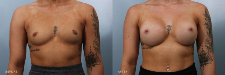 Side by side before and after of a woman's breasts from the front angle before breast augmentation surgery. Her breasts were small and flat and now they are several cup sizes bigger and more round. | Albany, Latham, Saratoga NY, Plastic Surgery