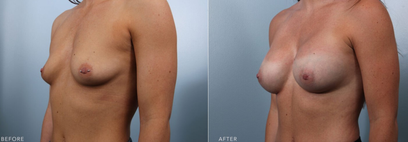 before and after photos of breast augmentation on 28 year old female 