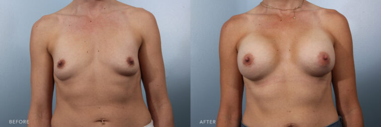 Side by side before and after of a woman who had breast augmentation surgery in Albany, NY. Her breasts went from flat and deflated to full and round. | Albany, Latham, Saratoga NY, Plastic Surgery