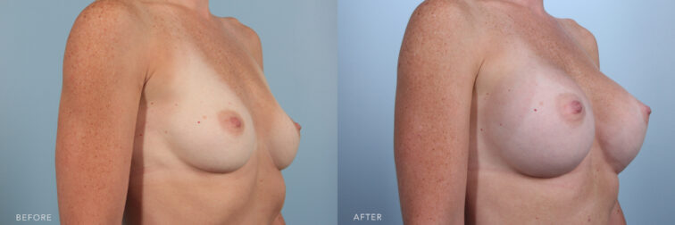 Side by side before and after of a woman who had a breast augmentation in Albany, NY. She had small breasts and now they are several cup sizes bigger. | Albany, Latham, Saratoga NY, Plastic Surgery