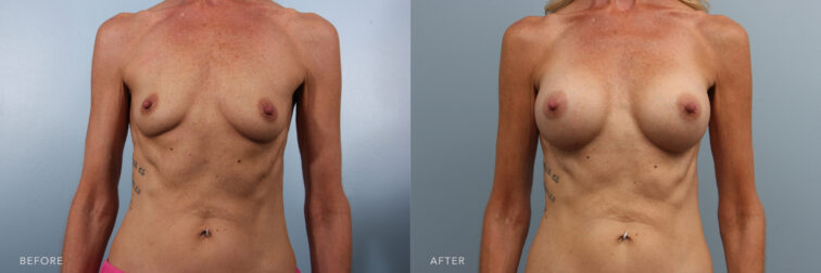 Side by side before and after of a woman who had breast augmentation surgery. In the before photo her breasts are very small and flat, after surgery they are larger and more full. | Albany, Latham, Saratoga NY, Plastic Surgery