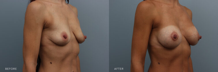Side by side before and after of a woman's breasts before and after breast augmentation surgery. Her breasts were flat and small looking deflated, and now they are slightly bigger but much more full looking. | Albany, Latham, Saratoga NY, Plastic Surgery