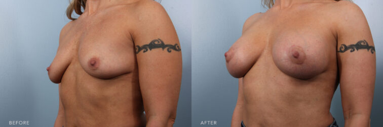 Side by side before and after of a woman who had a breast augmentation from a side angle. Her breasts were small and slightly deflated looking, now they are bigger and more round. | Albany, Latham, Saratoga NY, Plastic Surgery