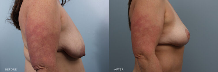 Side by side before and after of a woman who had a breast lift surgery in Albany, NY. Her breasts had a lot of drooping and now they are lifted back to normal position. | Albany, Latham, Saratoga NY, Plastic Surgery