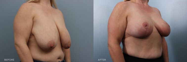 Side by side before and after of a woman's breasts taken from an angled view. Her breasts before breast lift surgery droop almost to her belly button. After surgery they are smaller and lifted back to normal position. | Albany, Latham, Saratoga NY, Plastic Surgery