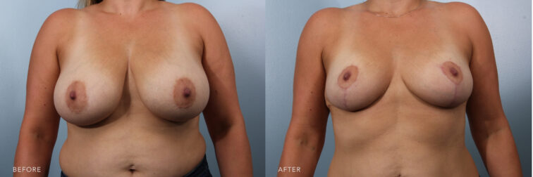 Side by side before and after of a woman's breasts before and after breast reduction surgery in Albany, NY. Her breasts were large and were then reduced to a smaller size and lifted. | Albany, Latham, Saratoga NY, Plastic Surgery