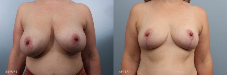 Side by side before and after of a woman who had a breast reduction in Albany, NY. Her breasts went from large and drooping to smaller and lifted. | Albany, Latham, Saratoga NY, Plastic Surgery
