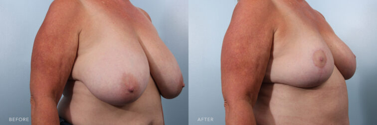 Side by side before and after of a woman from an angle who had a breast reduction in Albany, NY. Her breasts were large and drooping and now they are lifted and back to normal position. | Albany, Latham, Saratoga NY, Plastic Surgery