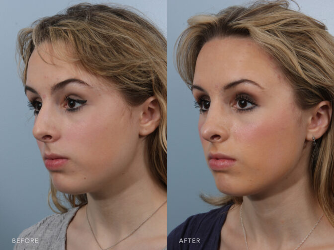 Side by side before and after of a young blonde woman's face from an angled view before and after a cosmetic rhinoplasty in Albany, NY. Her nose was large and had a nasal hump pre surgery and after the hump was removed and her nose is much more feminine looking. | Albany, Latham, Saratoga NY, Plastic Surgery