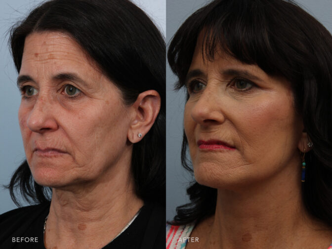Side by side before and after of a woman's face from the oblique view before and after facelift surgery. She had sagging skin around the face and neck that needed to be addressed. She now looks younger and happier. | Albany, Latham, Saratoga NY, Plastic Surgery