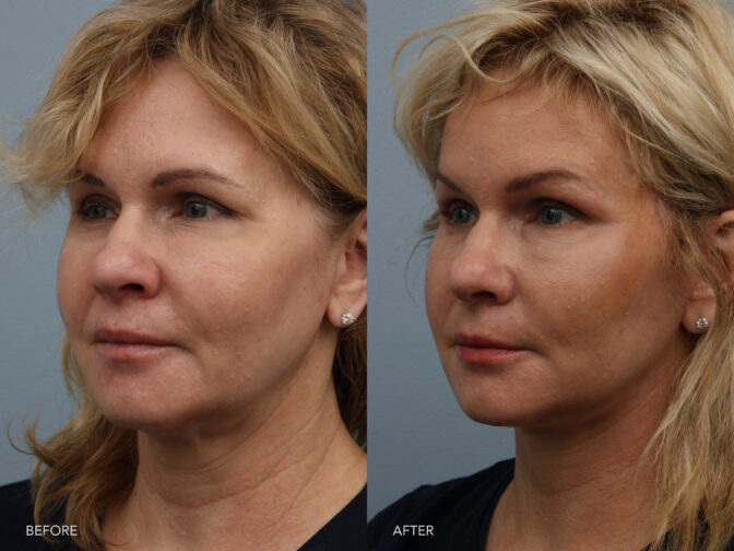 Side by side before and after of a woman who had a facelift in Albany, NY. All excess skin and fat in the lower face and neck has been removed leaving her looking thinner and younger. | Albany, Latham, Saratoga NY, Plastic Surgery