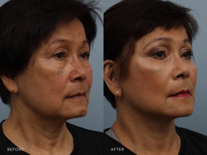 Side by side before and after from the oblique angle of a woman's face pre and post facelift surgery. Before she had loose skin on the face and neck and after she has no loose or sagging skin. Extra volume under her eyes have been removed helping her look less tired. | Albany, Latham, Saratoga NY, Plastic Surgery
