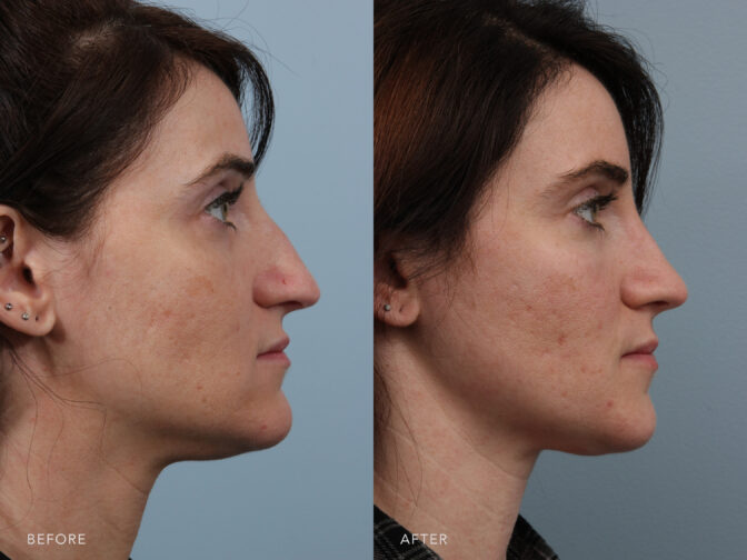 Side by side before and after of a woman who had rhinoplasty surgery in Albany, NY. She had a nasal hump that has been removed and her nose is now smaller and straighter. | Albany, Latham, Saratoga NY, Plastic Surgery