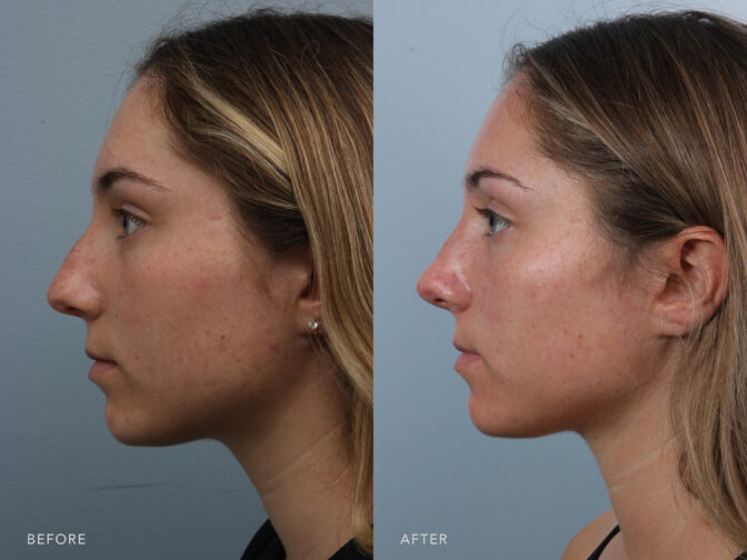 Side by side before and after of a young woman who had a rhinoplasty surgery in Albany, NY. Her nose had a slight bump to it that has been taken down to give her a more feminine looking nose. | Albany, Latham, Saratoga NY, Plastic Surgery