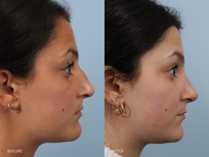 Side by side before and after of a young woman who had a rhinoplasty. She had a bump in her nose which was shaved down. There is still a small hump on the bridge but barely noticeable. | Albany, Latham, Saratoga NY, Plastic Surgery