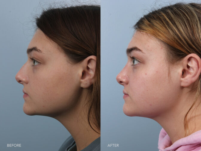 Side by side before and after from the side profile of a young female's face who had rhinoplasty surgery. Her nose before was large and had a nasal hump. After rhinoplasty surgery her nose is small and petite with a straight bridge. | Albany, Latham, Saratoga NY, Plastic Surgery