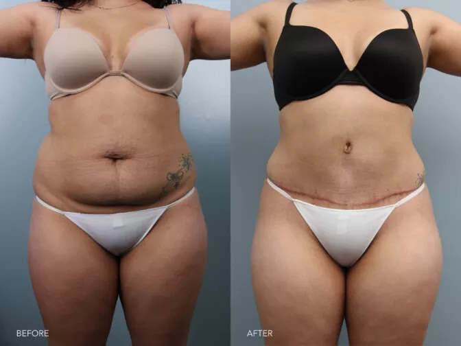 Before and after of a woman's midsection after having tummy tuck surgery in Albany, NY. She had excess skin and fat around her midsection that has been removed leaving her with a more flat and toned midsection. | Albany, Latham, Saratoga NY, Plastic Surgery