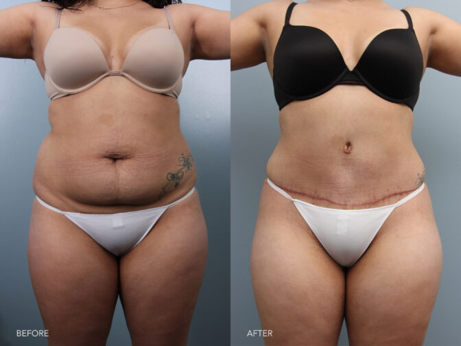 Tummy Tuck Austin Tx