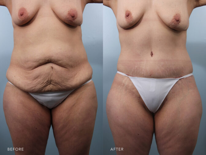 Before and after of a woman from the neck down who got a tummy tuck surgery. She had lots of loose skin surrounding the abdomen that has been removed, giving her a tight and toned stomach. | Albany, Latham, Saratoga NY, Plastic Surgery