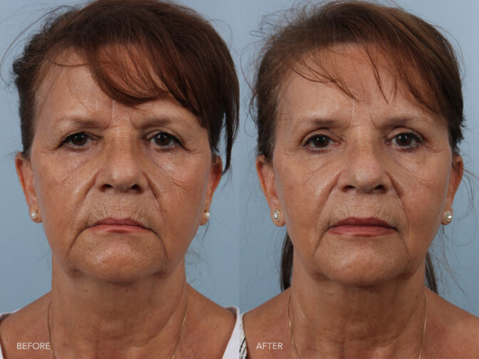 Side by Side before and after of a woman who had upper eyelid surgery. Excess skin around her upper eyelids have been removed to give her a younger appearance. | Albany, Latham, Saratoga NY, Plastic Surgery
