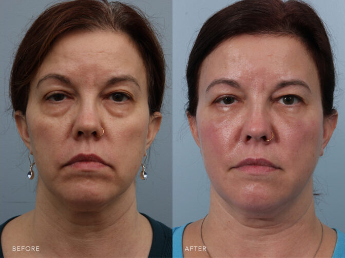 Side by side before and after of a woman who had a blepharoplasty procedure done. Before surgery she had heavy bags under her eyes that cause her face to appear droopy and tired. After surgery the volume under her eyes has been removed and her face looks younger and brighter. | Albany, Latham, Saratoga NY, Plastic Surgery