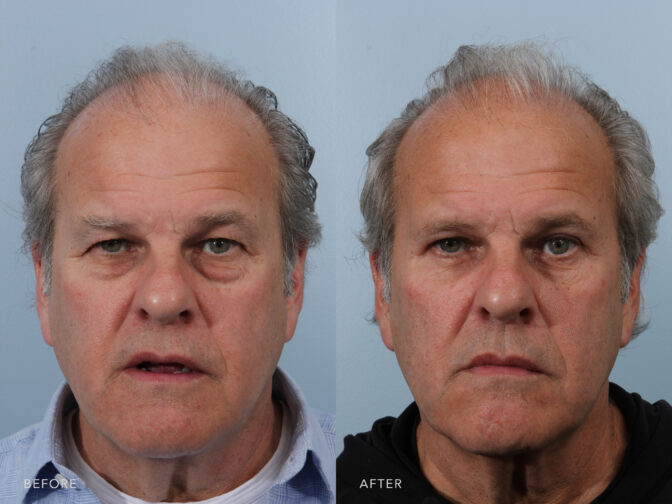 Before and after of an older man's face from the front view. In the left photo he has extra volume deposits under his eyes causing them to look like eyebags. In the right photo they are removed and his under eye area is smooth. | Albany, Latham, Saratoga NY, Plastic Surgery