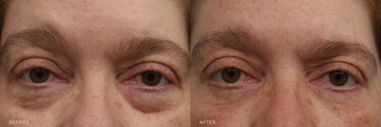 Side by side before and after of a woman's face from the forehead to the bottom of her nose. The before photo shows that she has very puffy under eyes that cause her to look very tired. The after photo shows that extra volume removed, and her under eyes are no longer puffy and tired looking. | Albany, Latham, Saratoga NY, Plastic Surgery