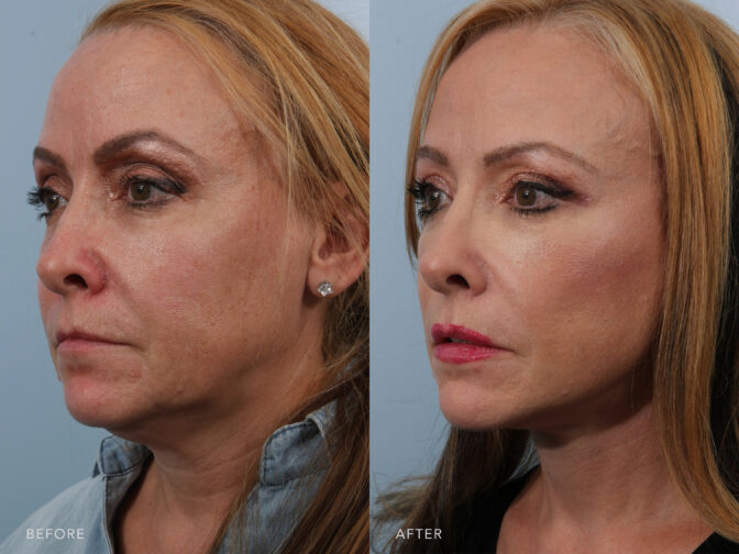 Side by side before and after of a woman's face and neck from the oblique angle. Before photo shows that she has excess skin around the neck and jowls. After photo shows loose and excess skin have been removed and she has a very taught facial structure following facelift surgery. | Albany, Latham, Saratoga NY, Plastic Surgery