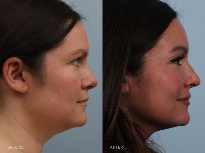A side-by-side view of a woman's face before and after Endonasal Cosmetic Rhinoplasty. Before photo shows lack of sharp angles of her nose, contributing to a less angular facial profile. While the after photo shows a well-defined angles, creating a more angular and structured appearance of her nasal tip. | Albany, Latham, Saratoga NY, Plastic Surgery