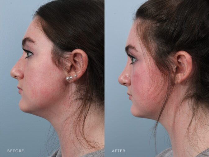 Side by side before and after of a young woman's side profile after rhinoplasty surgery. Her nose had a strong bridge, after surgery the bridge is sloped and the tip is lifted slightly giving her a more feminine nose. | Albany, Latham, Saratoga NY, Plastic Surgery