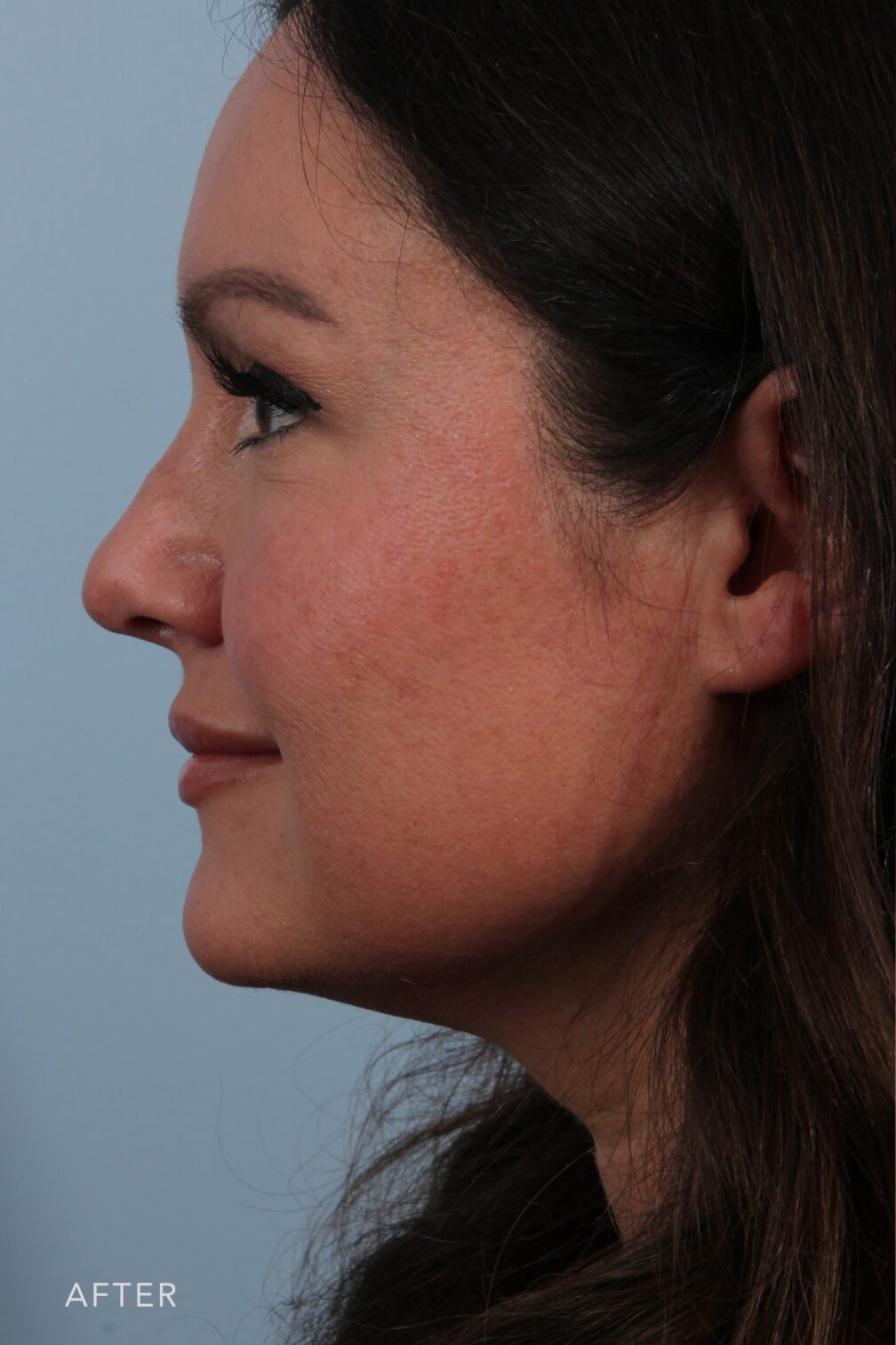 Rhinoplasty & Nasal Reconstruction Gallery | The Williams Center ...