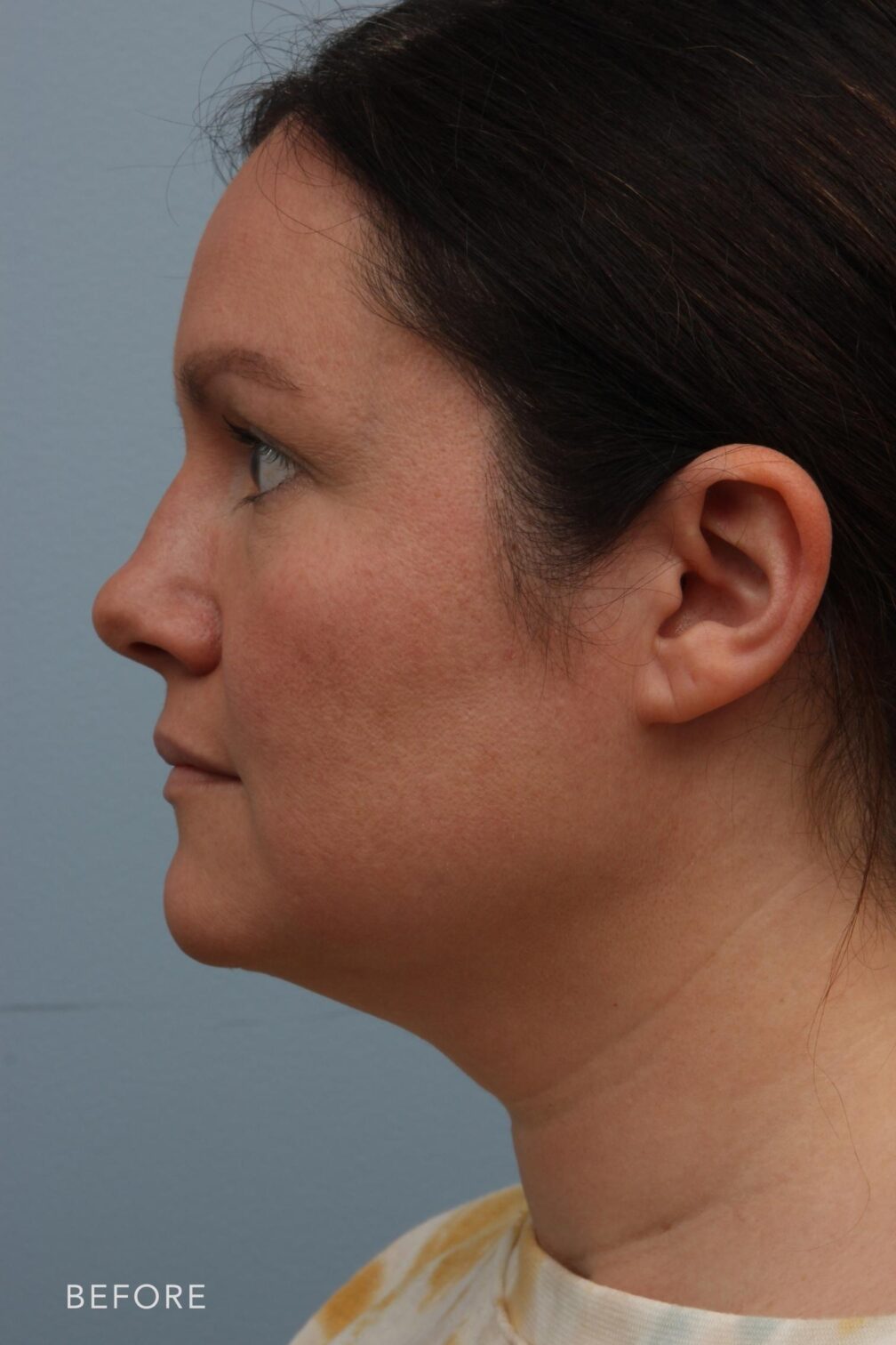 Rhinoplasty & Nasal Reconstruction Gallery | The Williams Center ...