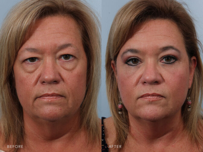 Side by side before and after of a woman from the front angle who had eyelid surgery. Before surgery she had heavy bags and puffiness under her eyes protruding out of her face. After surgery the bags were removed and her under eyes are now normal. She looks younger and less tired. | Albany, Latham, Saratoga NY, Plastic Surgery