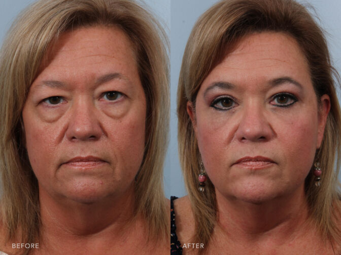 Lower Blepharoplasty Beverly Hills  Under Eye Bag  Dark Circle