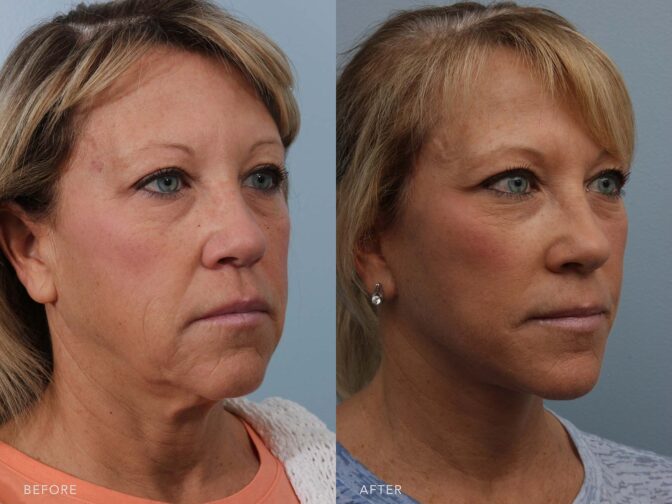 Before and after of a woman's face and neck from the side angle showing her results from facelift surgery. On the left in the before photo she has sagging jowls and loose skin. After surgery she has no loose skin or jowls and her face is pulled taught. She looks younger following surgery. | Albany, Latham, Saratoga NY, Plastic Surgery