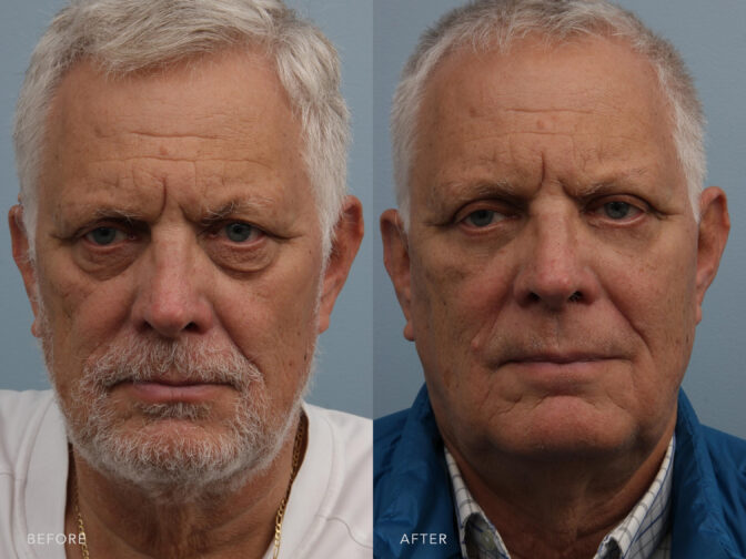 Before and after of an older man with white hair taken from the front angle before and after blepharoplasty surgery. Before surgery he had heavy and wrinkly eyebags that caused him to look very old and tired. After surgery those bags are removed and he has smooth and youthful under eyes. | Albany, Latham, Saratoga NY, Plastic Surgery