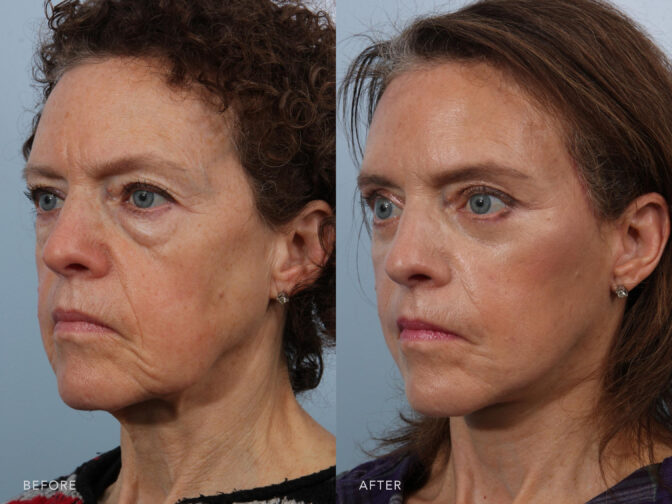 Before and after of a woman's face who had facelift surgery. Before she had a lot of loose skin and saggy jowls, afterwards she had pulled taught skin and looks years younger. | Albany, Latham, Saratoga NY, Plastic Surgery