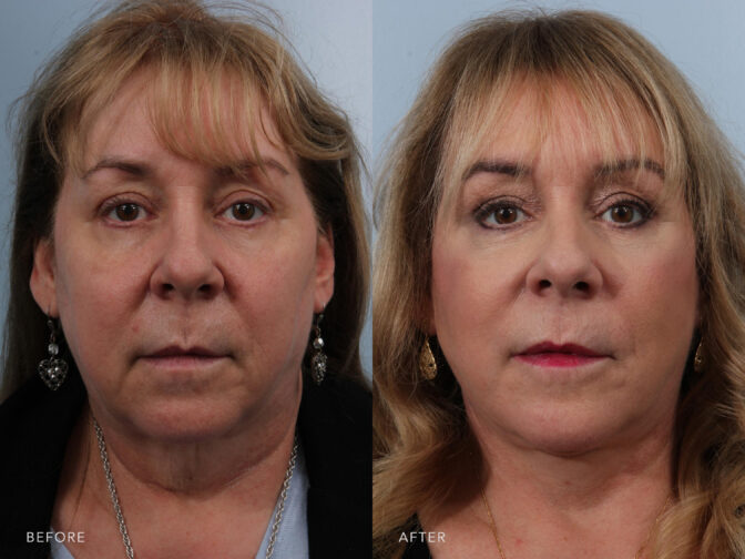 Side by side before and after of an older woman with dirty blonde mid length hair pre and post facelift surgery. Before surgery she had very heavy and saggy jowls that created a turkey neck appearance and loose skin and fat around the mid face that caused her to look old. After facelift surgery the sagging jowls were removed and her face is tightened giving her a more youthful appearance. | Albany, Latham, Saratoga NY, Plastic Surgery