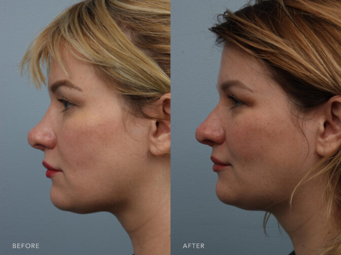 Side by side before and after of an adult blonde woman from the side profile angle for revision rhinoplasty surgery. Before surgery her nasal tip was very up turned giving her a ski slope nose. After revision rhinoplasty her nose bridge is less sloped and more straight. | Albany, Latham, Saratoga NY, Plastic Surgery