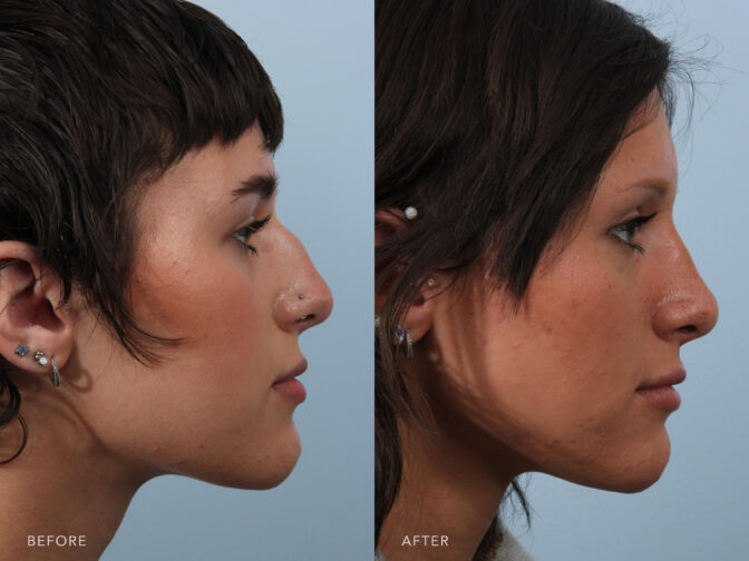 Side by side before and after of a young woman with short brown hair from the side profile angle. She had a rhinoplasty surgery done in albany, latham, saratoga, NY. Before surgery her nose was very large and had a large nasal hump that protruded from her face. After surgery her nose is much smaller and more feminine, there is still a small nasal bump but barely noticeable. | Albany, Latham, Saratoga NY, Plastic Surgery